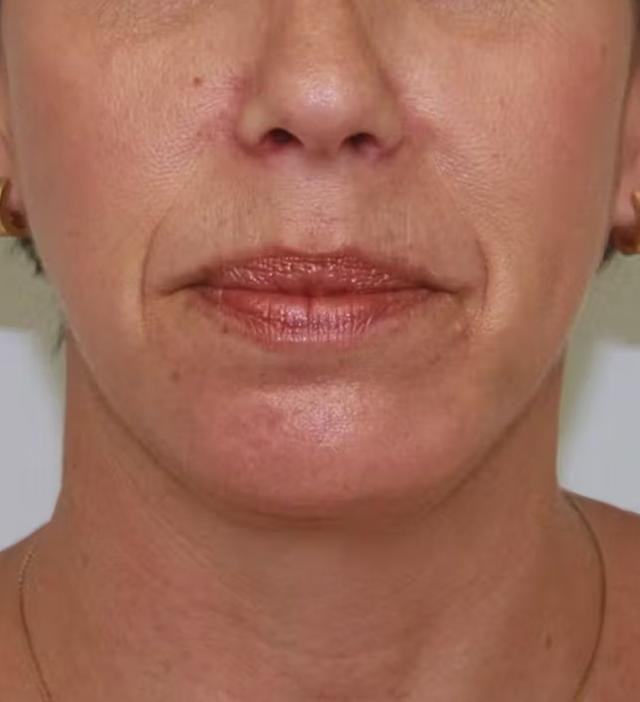 Chin Implant after at Palm Beach Facial Plastic Surgery in Palm Beach Gardens, FL