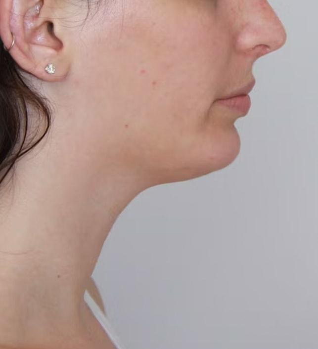 Palm Beach Facial Plastic Surgery chin implant after — Palm Beach Gardens, FL