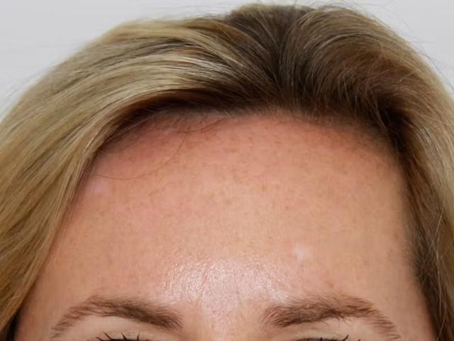 Botox after at Palm Beach Facial Plastic Surgery in Palm Beach Gardens, FL