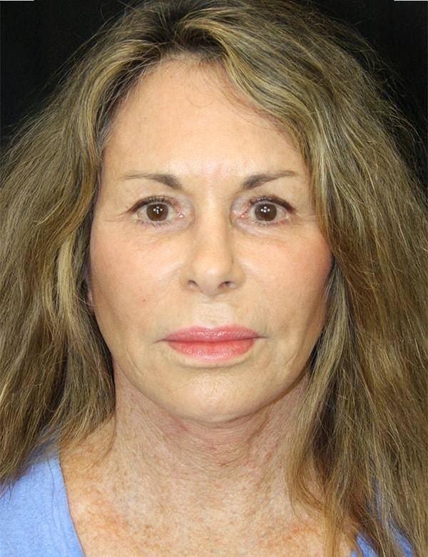 Palm Beach Facial Plastic Surgery facelift after — Palm Beach Gardens, FL