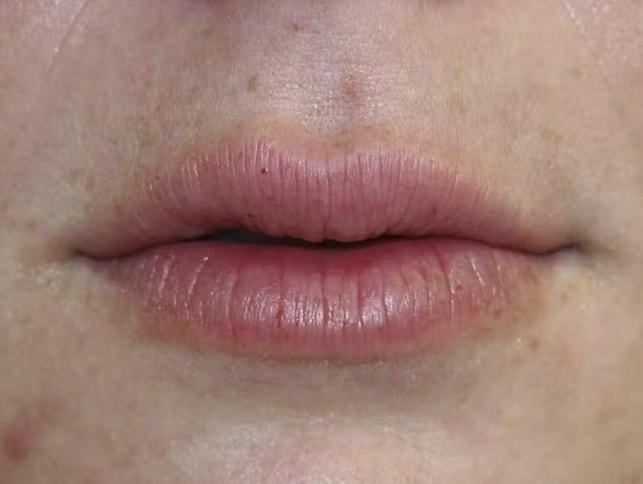Palm Beach Facial Plastic Surgery lip filler after — Palm Beach Gardens, FL