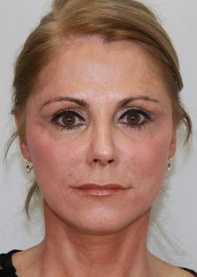 Fat Transfer before at Palm Beach Facial Plastic Surgery in Palm Beach Gardens, FL