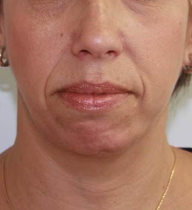 Chin Implant before at Palm Beach Facial Plastic Surgery in Palm Beach Gardens, FL