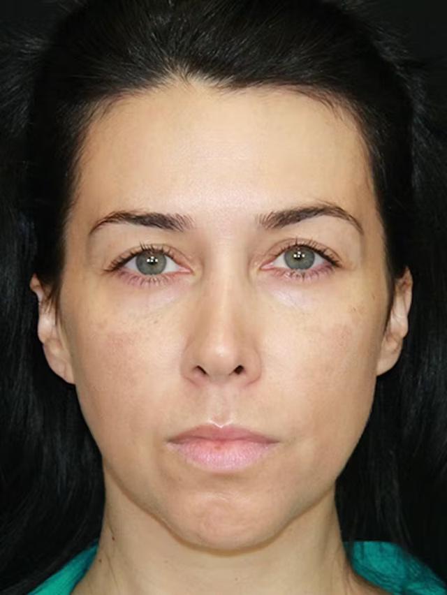 Brow Lift before at Palm Beach Facial Plastic Surgery in Palm Beach Gardens, FL