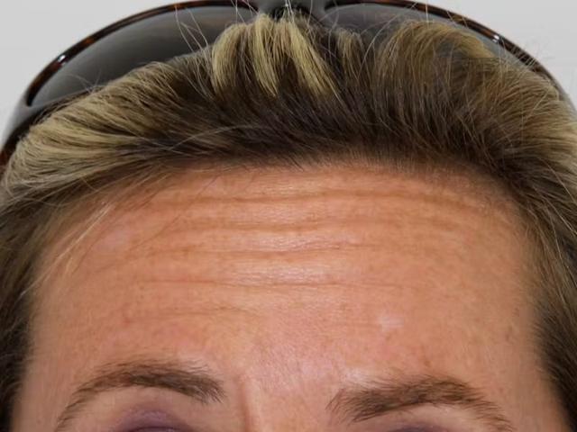 Botox before at Palm Beach Facial Plastic Surgery in Palm Beach Gardens, FL