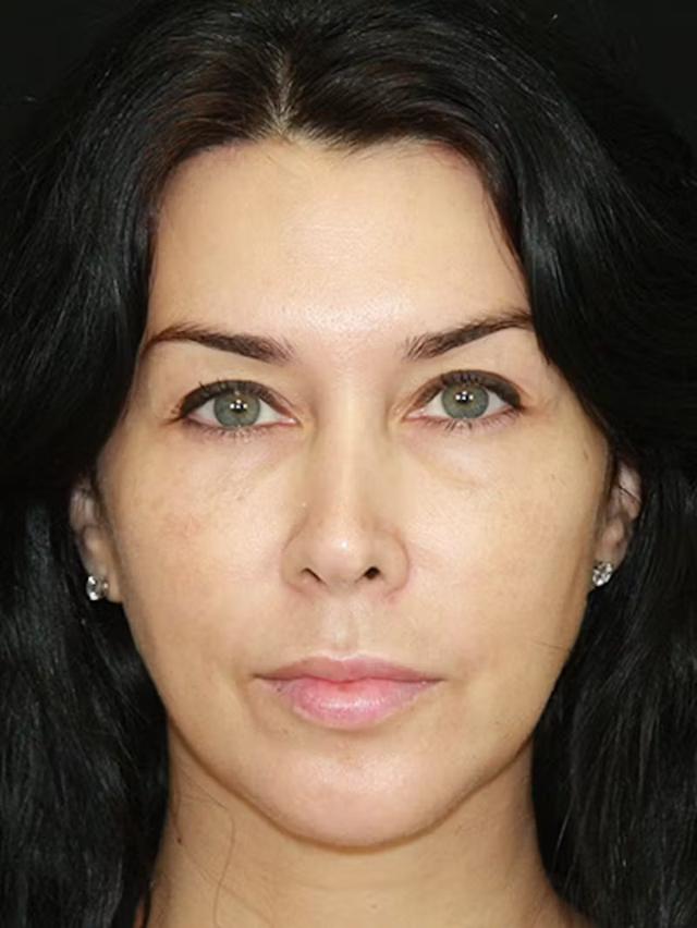 Brow Lift after at Palm Beach Facial Plastic Surgery in Palm Beach Gardens, FL