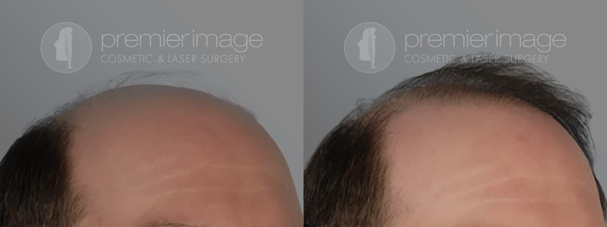 Premier Image Cosmetic & Laser Surgery hair restoration result — Atlanta, GA