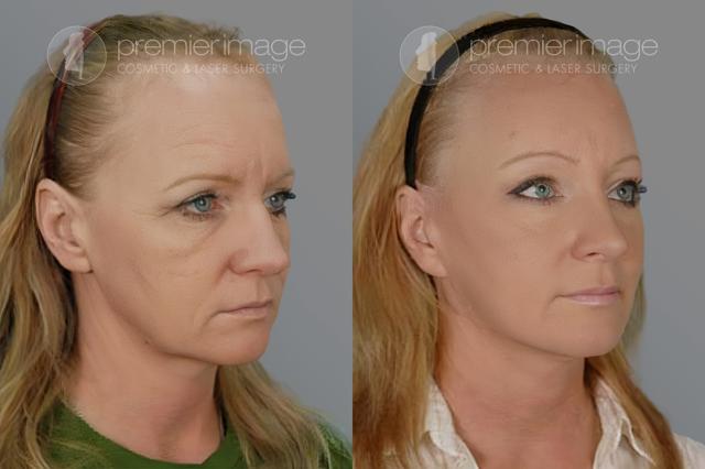 Brow Lift result at Premier Image Cosmetic & Laser Surgery in Atlanta, GA