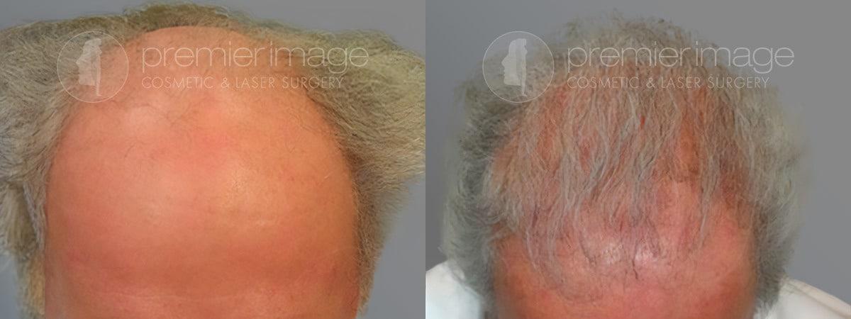 Premier Image Cosmetic & Laser Surgery hair restoration result — Atlanta, GA