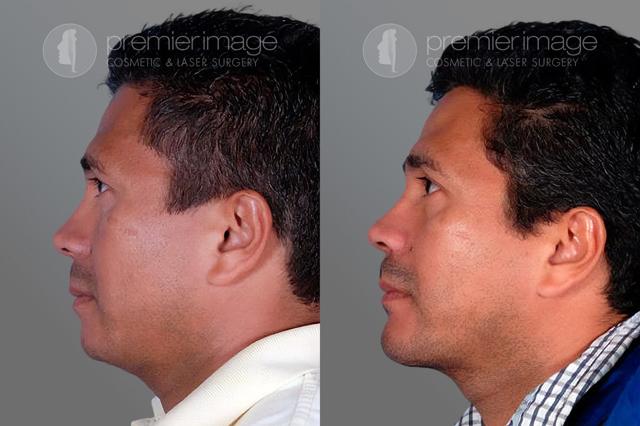 Chin Implant result at Premier Image Cosmetic & Laser Surgery in Atlanta, GA