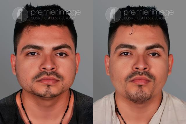 Chin Implant result at Premier Image Cosmetic & Laser Surgery in Atlanta, GA