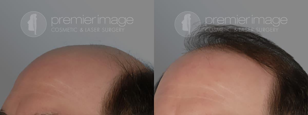 Premier Image Cosmetic & Laser Surgery hair restoration result — Atlanta, GA