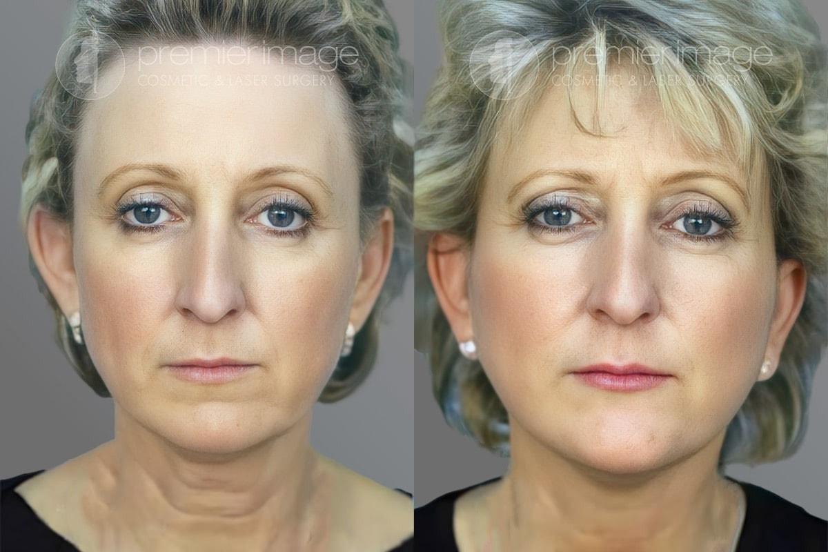 Premier Image Cosmetic & Laser Surgery facelift result — Sandy Springs, GA