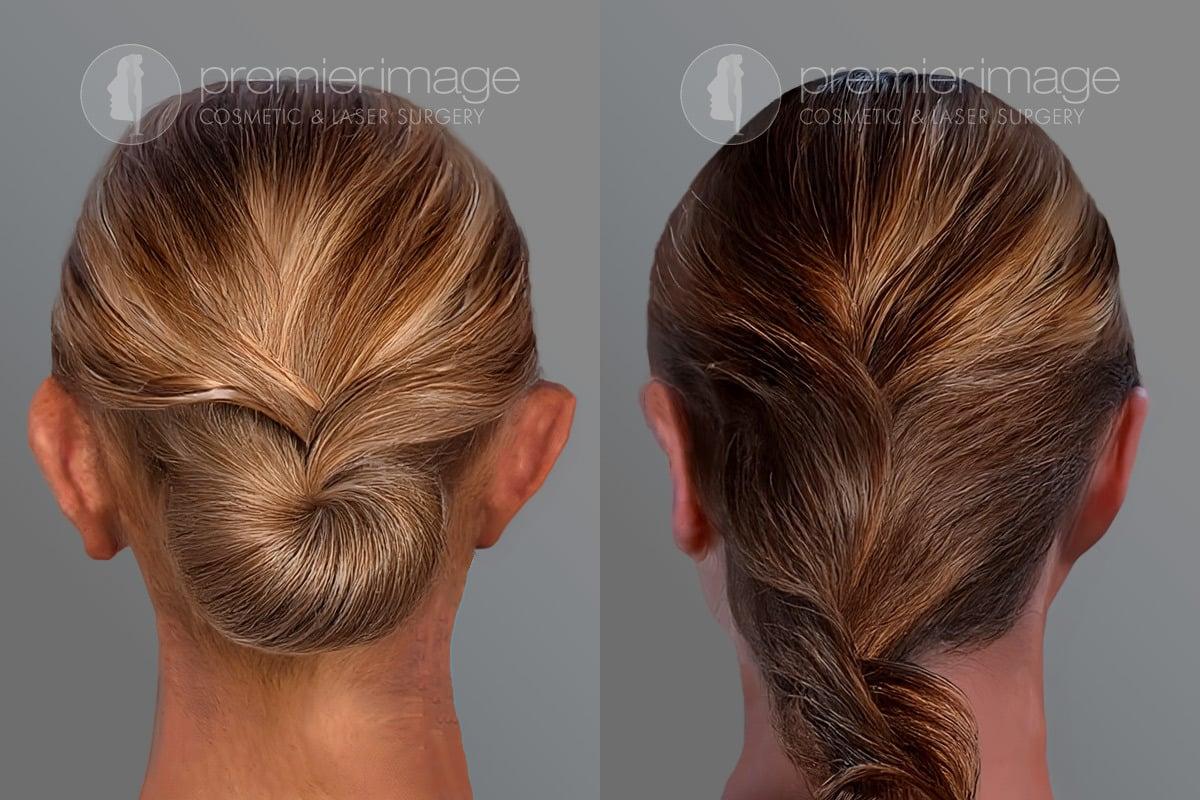 Premier Image Cosmetic & Laser Surgery otoplasty result — Atlanta, GA