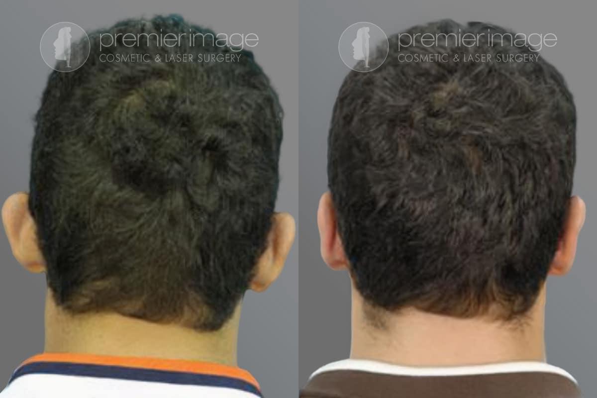 Premier Image Cosmetic & Laser Surgery otoplasty result — Atlanta, GA