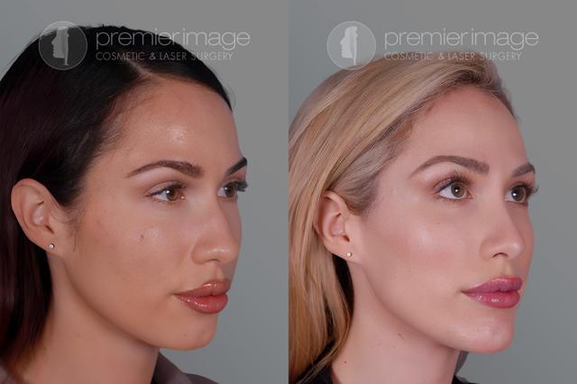 Chin Implant result at Premier Image Cosmetic & Laser Surgery in Atlanta, GA