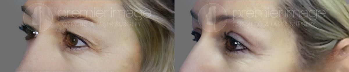 Premier Image Cosmetic & Laser Surgery blepharoplasty result — Atlanta, GA