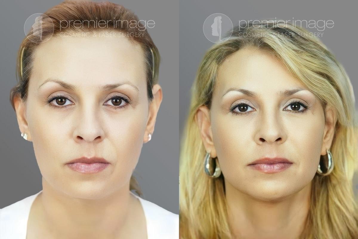 Premier Image Cosmetic & Laser Surgery facelift result — Sandy Springs, GA