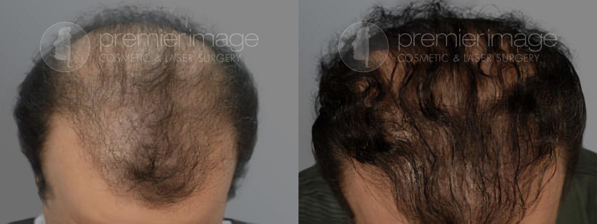 Premier Image Cosmetic & Laser Surgery hair restoration result — Atlanta, GA