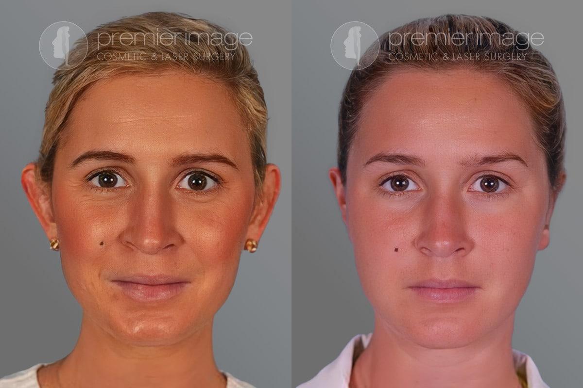 Premier Image Cosmetic & Laser Surgery otoplasty result — Atlanta, GA