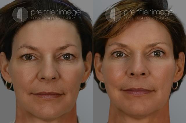 Blepharoplasty result at Premier Image Cosmetic & Laser Surgery in Atlanta, GA