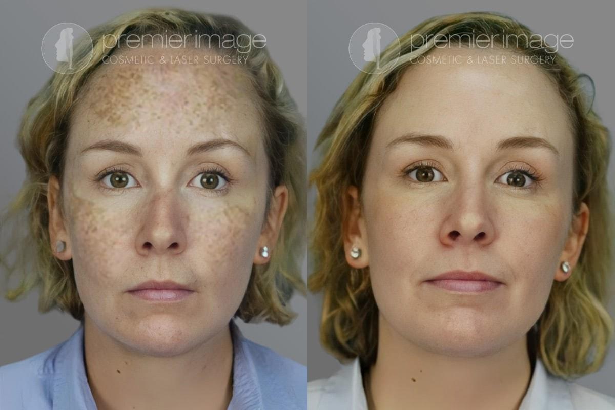 Premier Image Cosmetic & Laser Surgery laser treatment result — Sandy Springs, GA