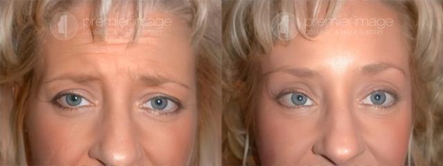 Brow Lift result at Premier Image Cosmetic & Laser Surgery in Atlanta, GA