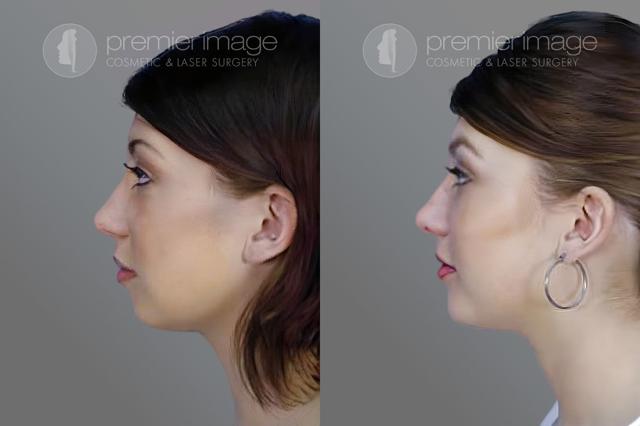Chin Implant result at Premier Image Cosmetic & Laser Surgery in Atlanta, GA