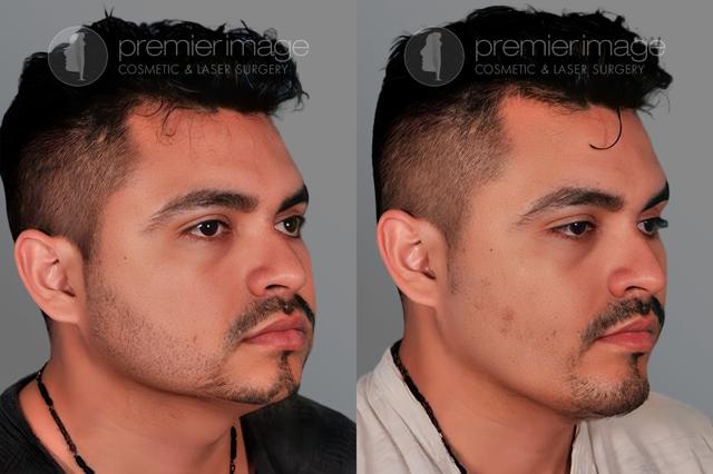 Chin Implant result at Premier Image Cosmetic & Laser Surgery in Atlanta, GA