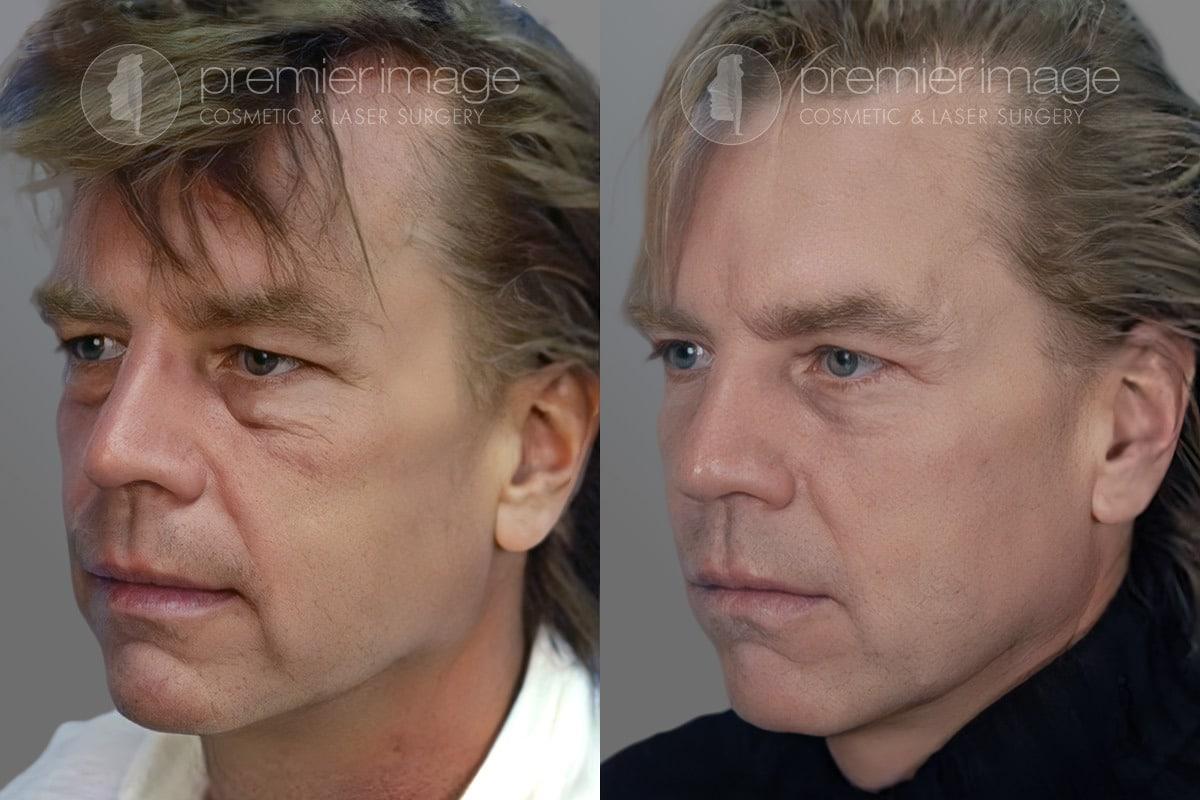 Premier Image Cosmetic & Laser Surgery blepharoplasty result — Atlanta, GA