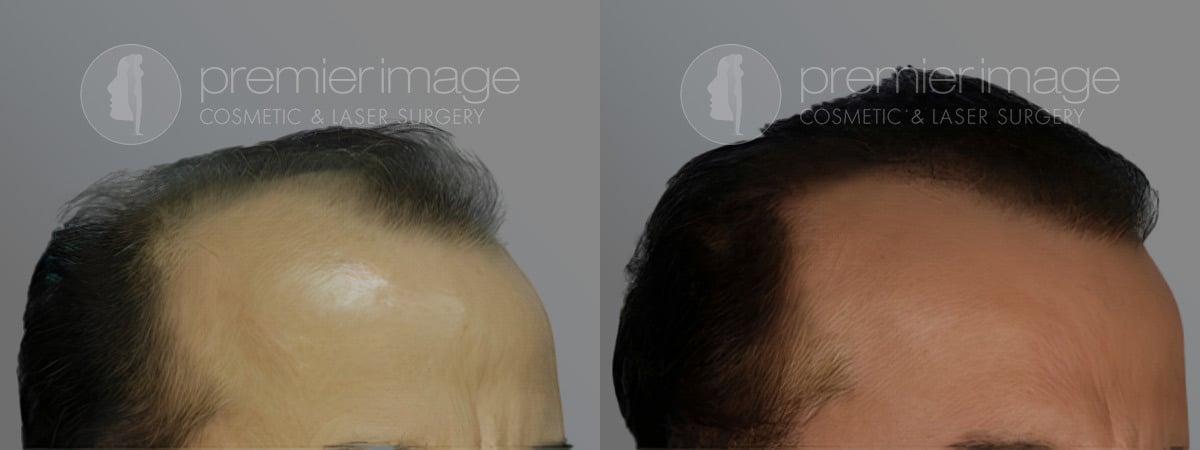 Premier Image Cosmetic & Laser Surgery hair restoration result — Atlanta, GA