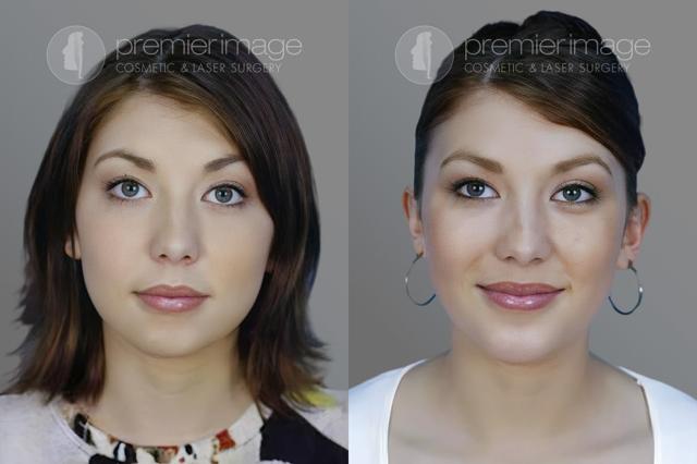 Chin Implant result at Premier Image Cosmetic & Laser Surgery in Atlanta, GA