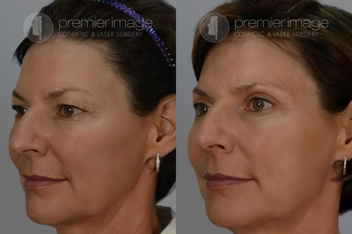 Premier Image Cosmetic & Laser Surgery blepharoplasty result — Atlanta, GA