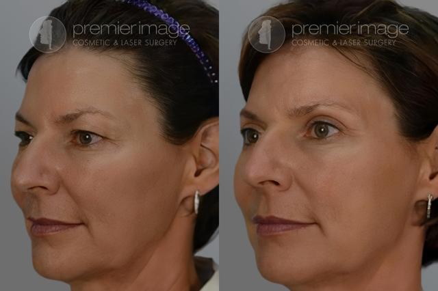 Blepharoplasty result at Premier Image Cosmetic & Laser Surgery in Atlanta, GA