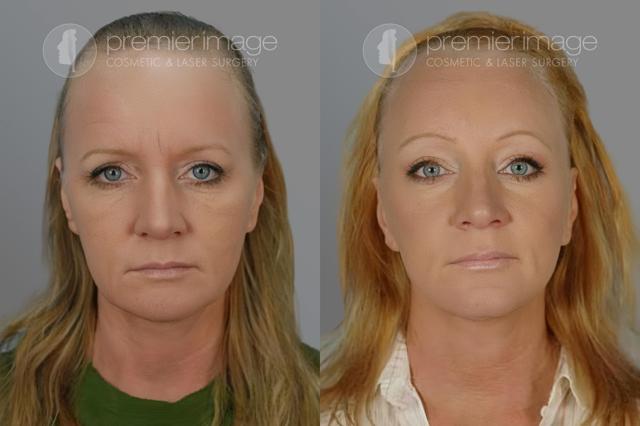 Brow Lift result at Premier Image Cosmetic & Laser Surgery in Atlanta, GA