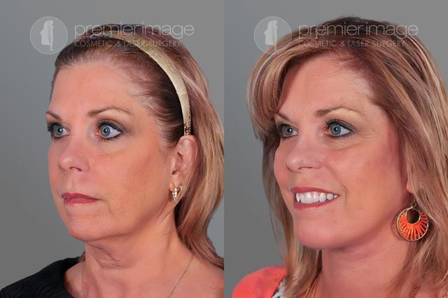 Chin Implant result at Premier Image Cosmetic & Laser Surgery in Atlanta, GA