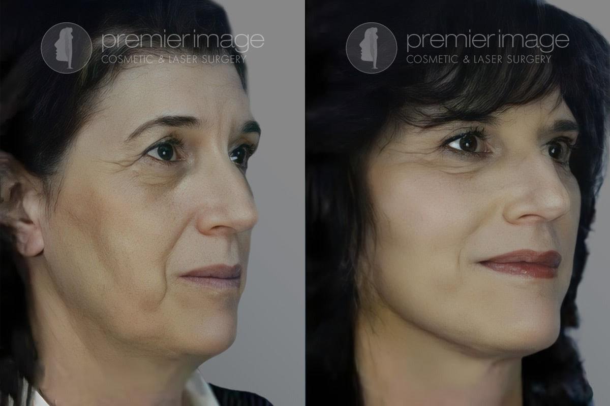 Premier Image Cosmetic & Laser Surgery facelift result — Sandy Springs, GA