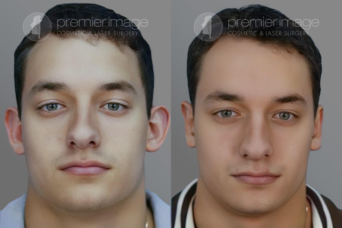 Premier Image Cosmetic & Laser Surgery otoplasty result — Atlanta, GA