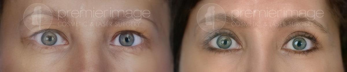 Premier Image Cosmetic & Laser Surgery blepharoplasty result — Atlanta, GA