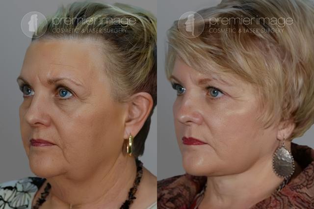 Neck Lift result at Premier Image Cosmetic & Laser Surgery in Atlanta, GA