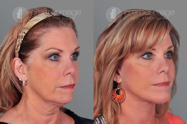 Chin Implant result at Premier Image Cosmetic & Laser Surgery in Atlanta, GA
