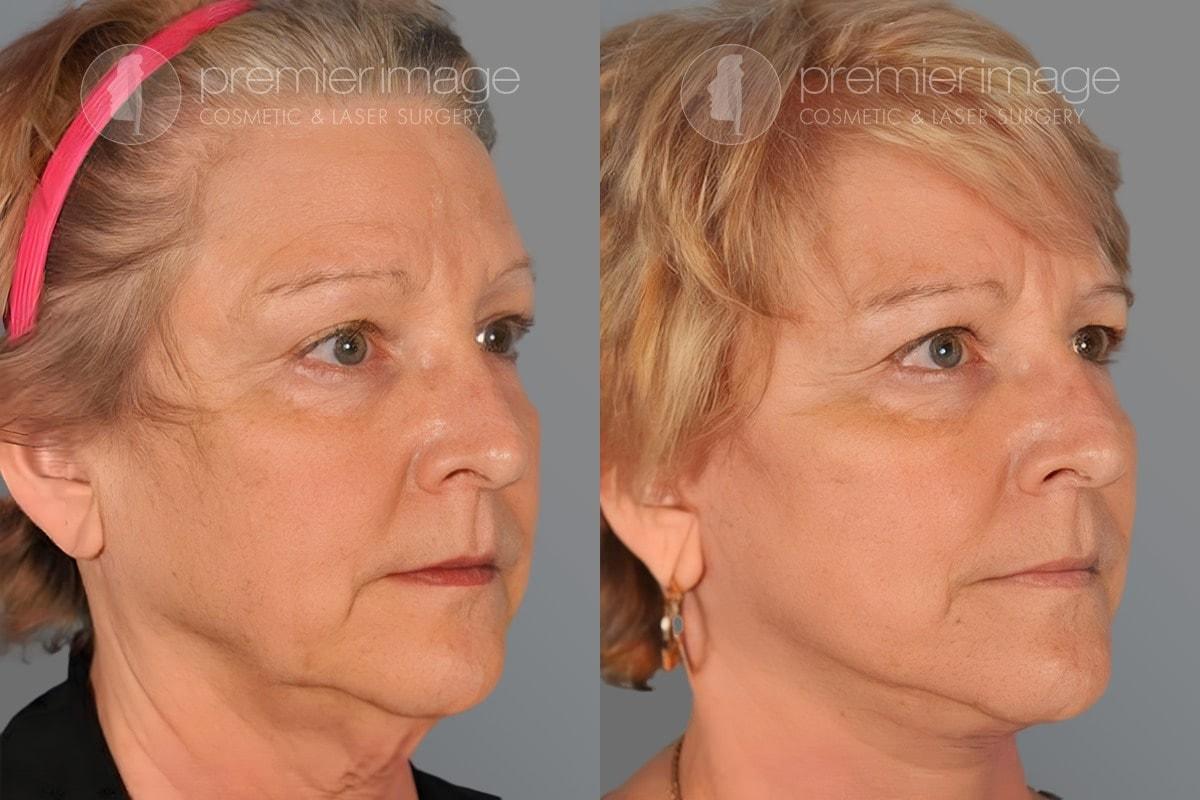 Premier Image Cosmetic & Laser Surgery facelift result — Sandy Springs, GA