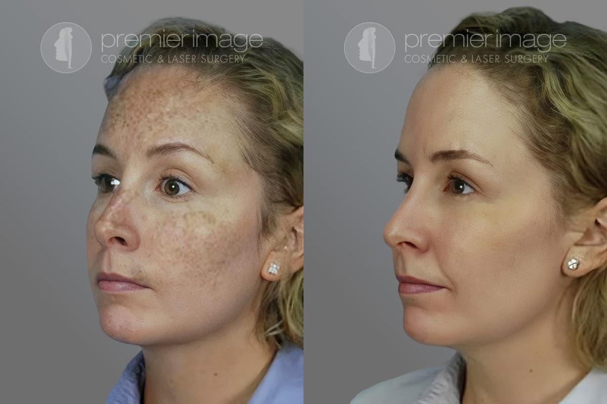 Premier Image Cosmetic & Laser Surgery laser treatment result — Sandy Springs, GA