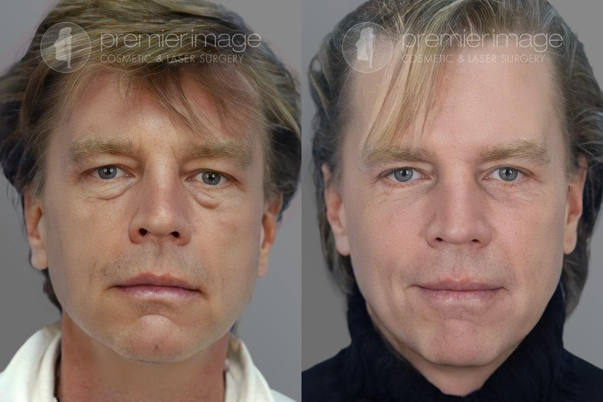 Premier Image Cosmetic & Laser Surgery blepharoplasty result — Atlanta, GA