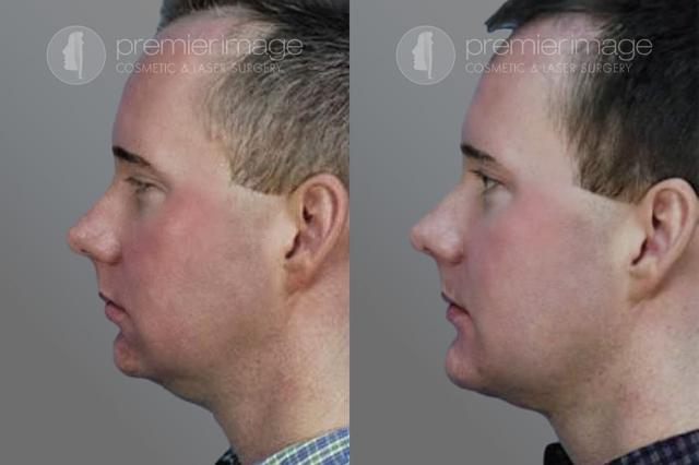 Chin Implant result at Premier Image Cosmetic & Laser Surgery in Atlanta, GA