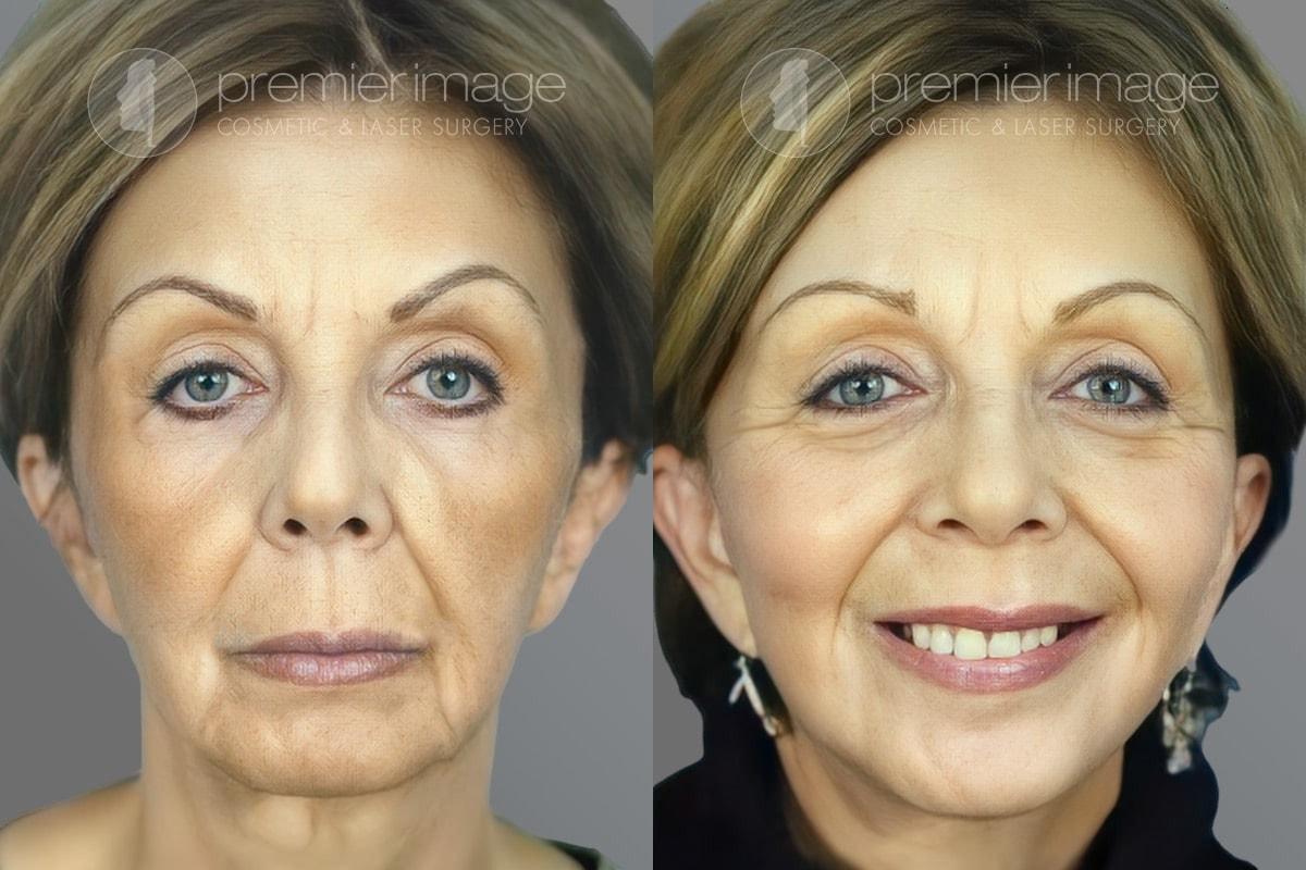Premier Image Cosmetic & Laser Surgery facelift result — Sandy Springs, GA