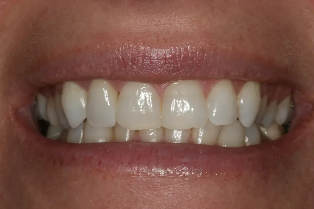 Rod Gleave DMD dental crowns after — Salt Lake City, UT