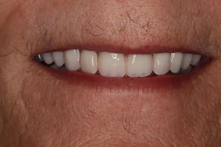 Rod Gleave DMD dental implants after — Salt Lake City, UT