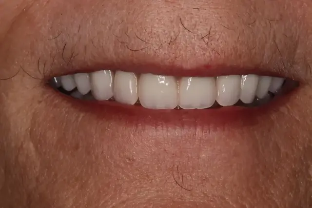 Dental Implants after at Rod Gleave DMD in Salt Lake City, UT