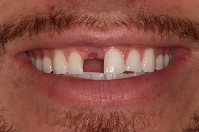Dental Implants before at Rod Gleave DMD in Salt Lake City, UT